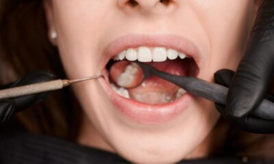 Dental Bonding