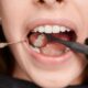 Dental Bonding