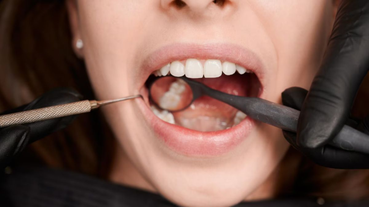 Dental Bonding