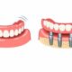 Dentures