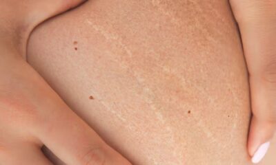 Stretch Marks Treatments
