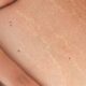 Stretch Marks Treatments