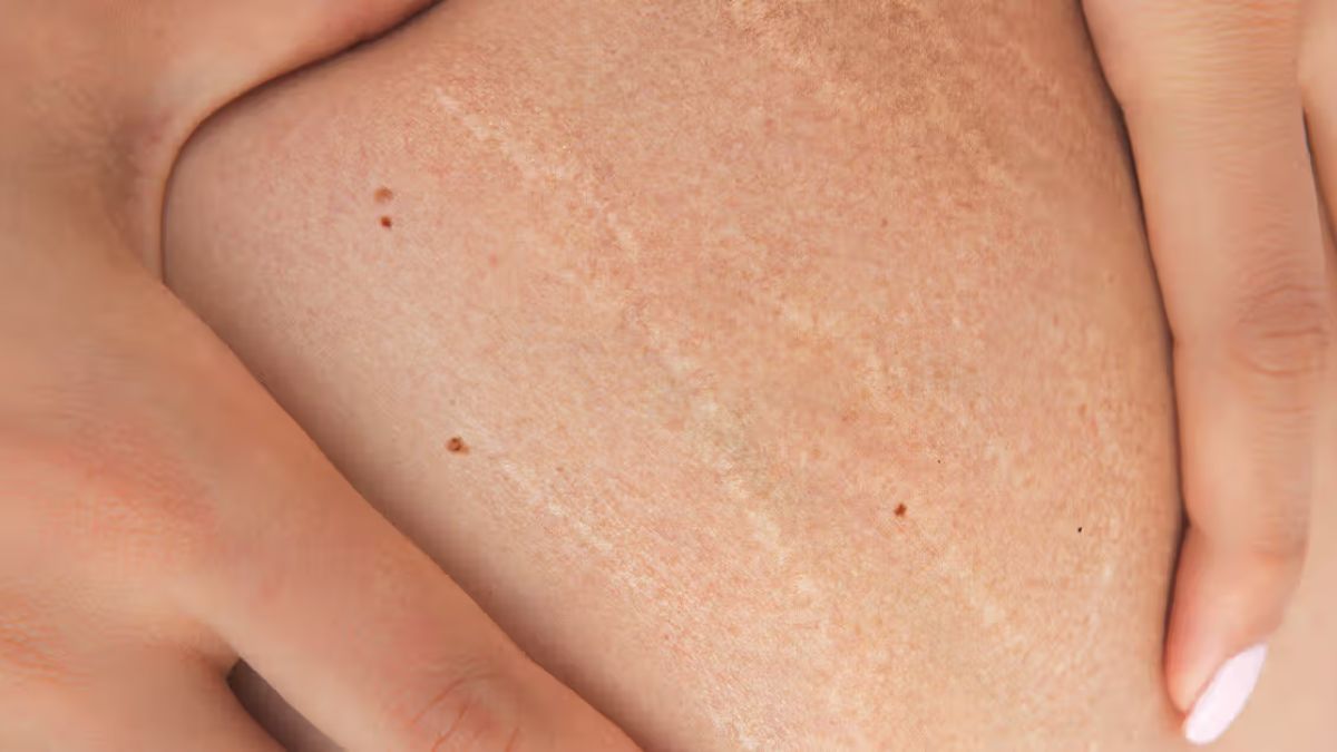 Stretch Marks Treatments