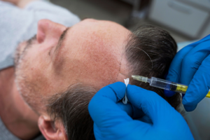 What is PRP Hair Therapy