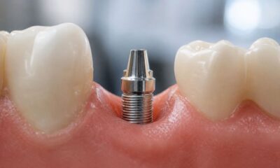 Dental Implants