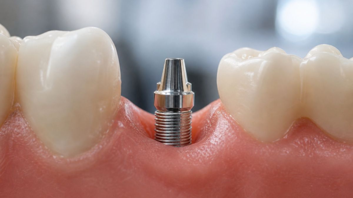Dental Implants